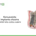 Remedium-ROOTT-implanti-2.jpg